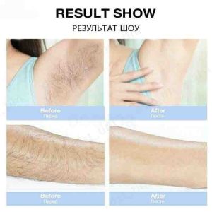 دستگاه لیزر خانگی حذف موهای زائد 900 هزار شات مدل AM001
